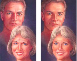 Brow Lift