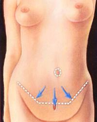 Abdomin before