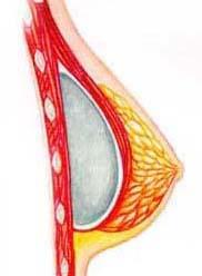 Breast - submuscular
