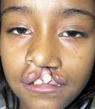 Cleft