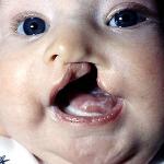 Cleft