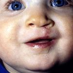 Cleft
