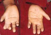 Hand differences