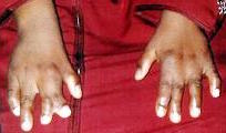 Hand differences